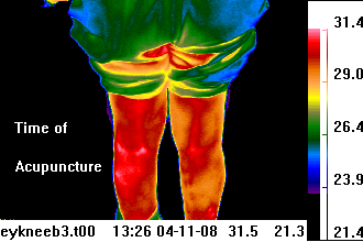 Before acupuncture infrared thermal imaging