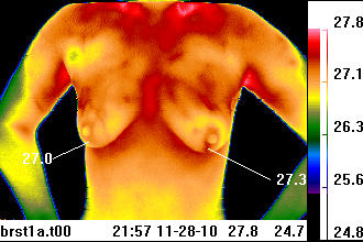 Thermal image of breasts