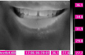Thermal image of mouth with teeth