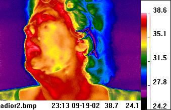 Teletherm thermal image of human face