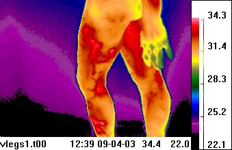 thermogram of lower extremities