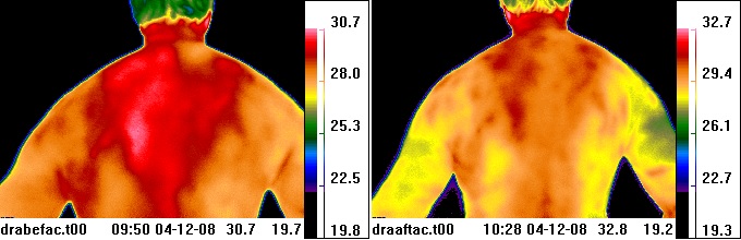 thermal image before & after
                        acupuncture
