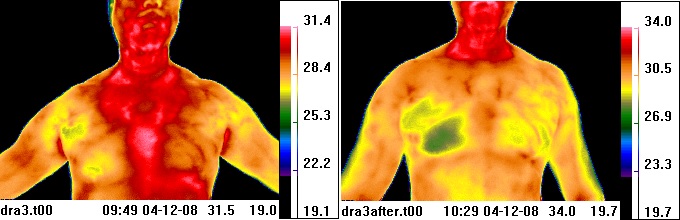 thermal image of chest before &
                        after acupuncture