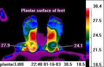 Teletherm infrared image of plantar
                            feet