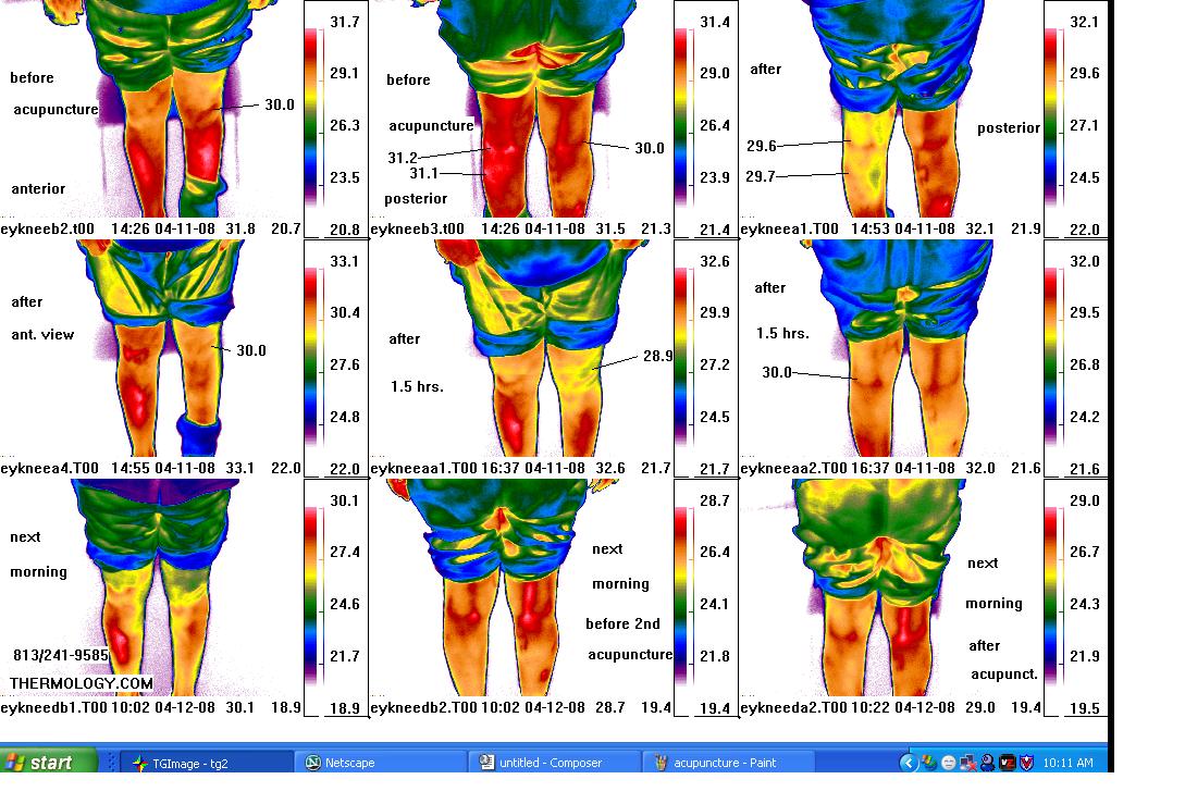 acupuncture before after series thermal
                        images